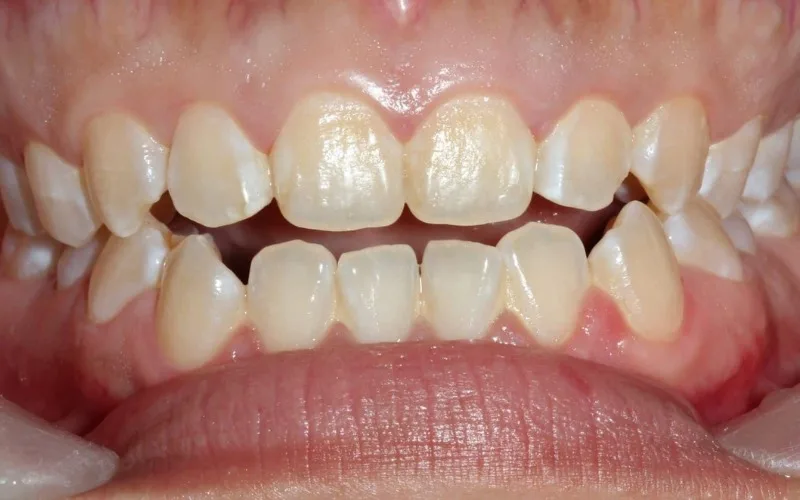 Açık Kapanış (Open Bite)