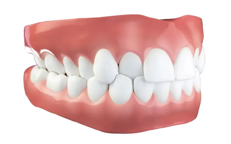 Çapraz Kapanış (Crossbite)