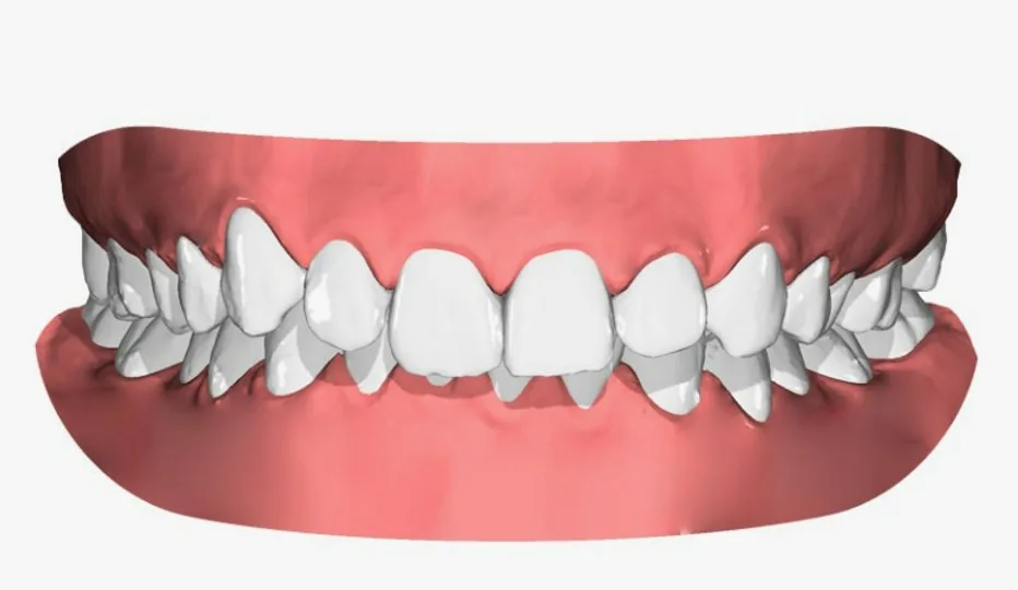 Derin Kapanış (Deep Bite)