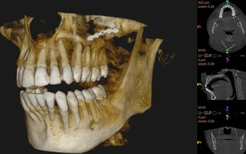 Çene Eklemi CBCT (Konik Işınlı Tomografi)